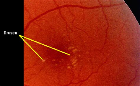 Retinal Drusen: Everything You Need to Know .